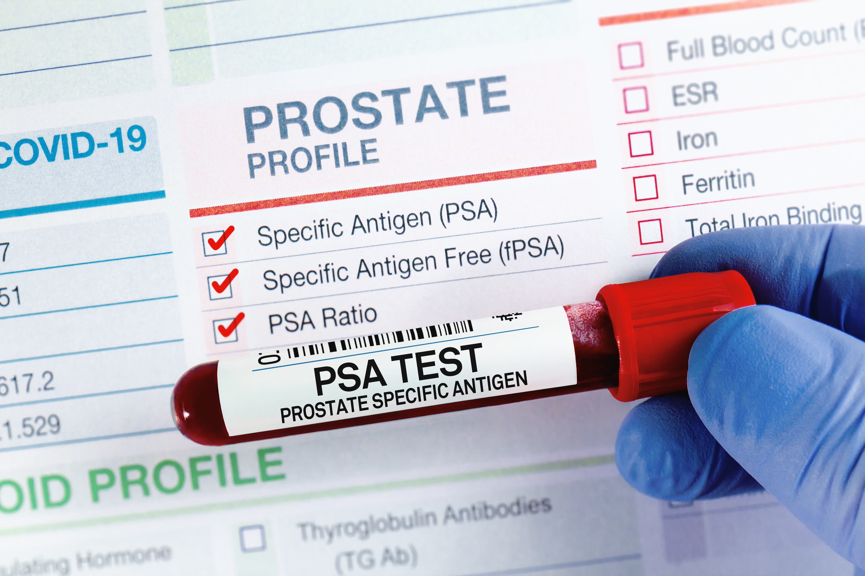 Prostate-Specific Antigen (PSA)